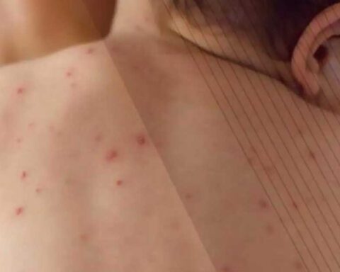 Espalda de un niño con sarampión.