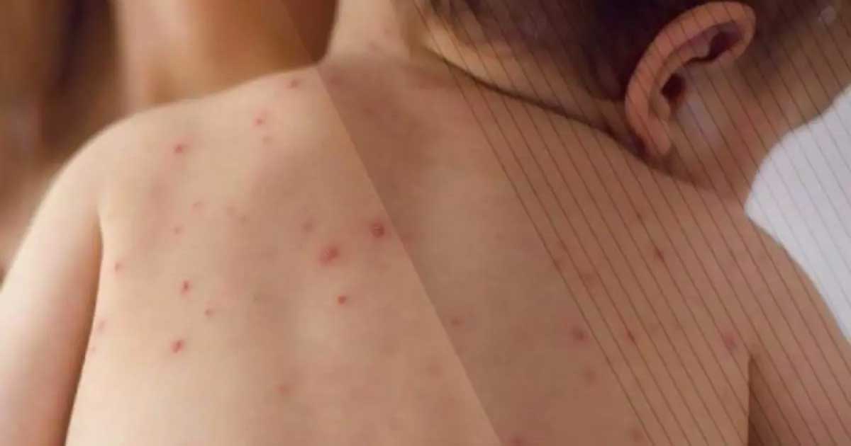 Espalda de un niño con sarampión.
