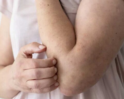 El brazo de una persona con sarampión.