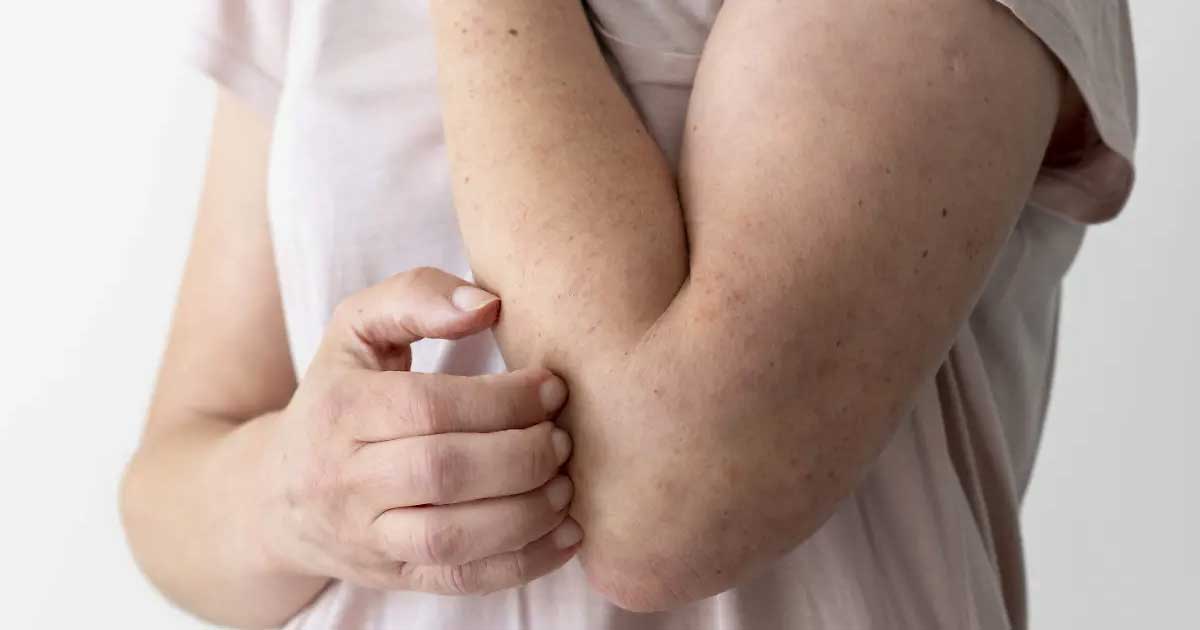 El brazo de una persona con sarampión.